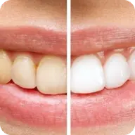 ¿Por qué mis dientes están amarillos si me cepillo todos los días?