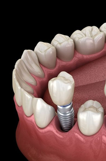 Implantes dentales