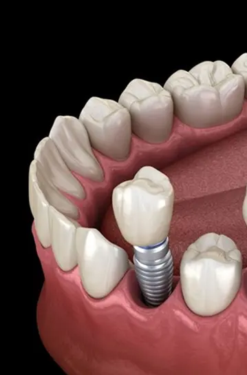 Imagen de Implantes dentales
