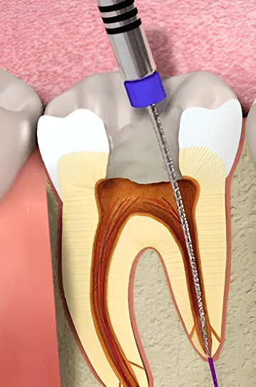 Endodoncia