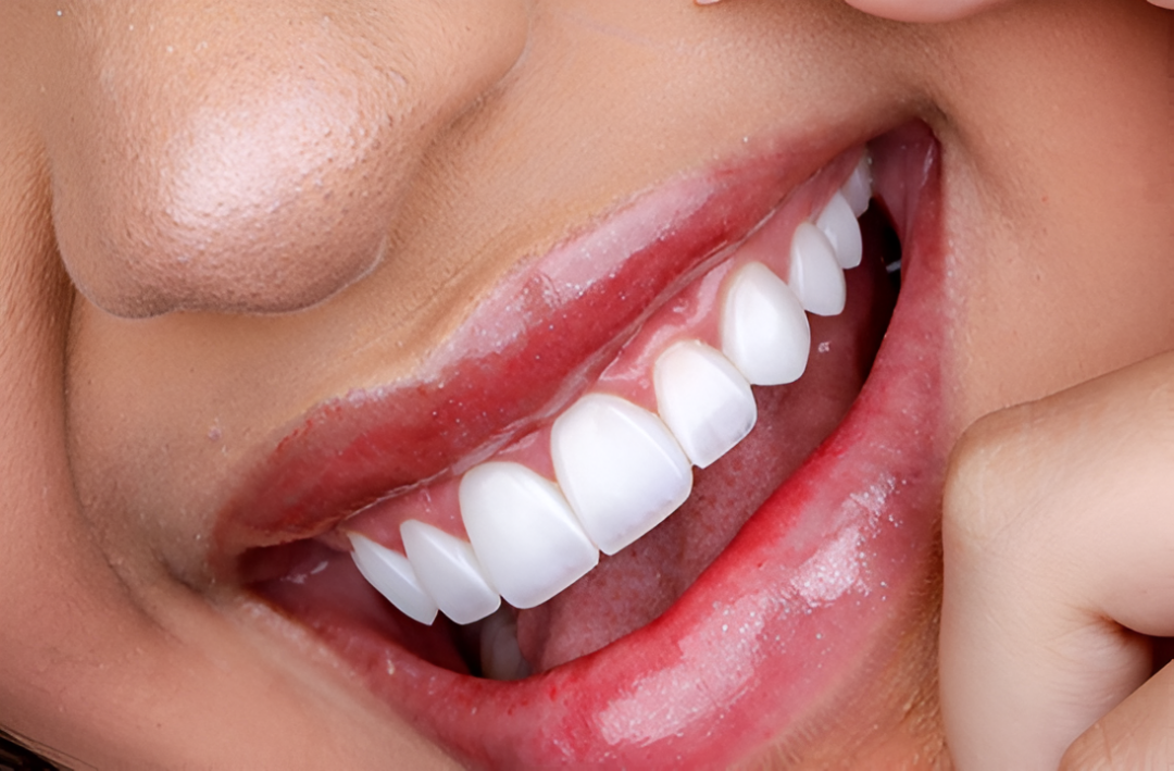 Imagen ilustrativa sobre Blanqueamiento dental