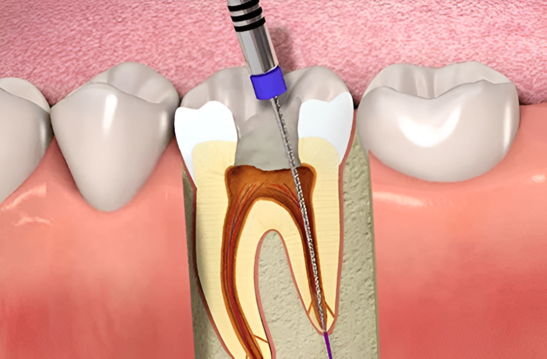 Imagen ilustrativa sobre Endodoncia